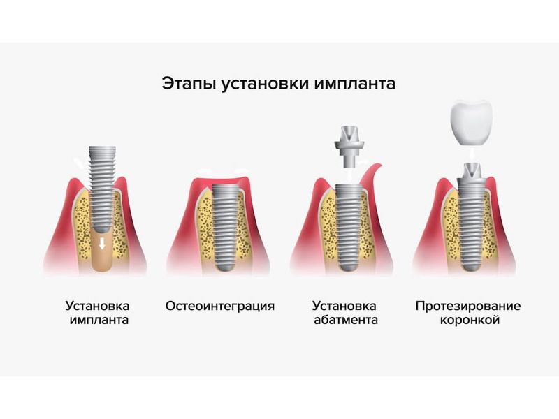 Схема «Этапы установки импланта»: установка импланта, остеоинтеграция, установка абатмента, протезирование коронкой